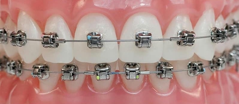 Metal self ligating braces